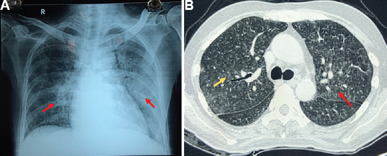 (A) Chest Radiograph showing bilateral heterogeneous infiltrates (red arrows) affecting the left more than right lung and (B) Computed Tomography of the chest showing bilateral ground glass opacities (red arrow) and centrilobular nodules (yellow arrow) predominantly affecting the middle and lower lobes.